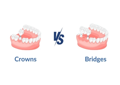 Crowns vs Bridges